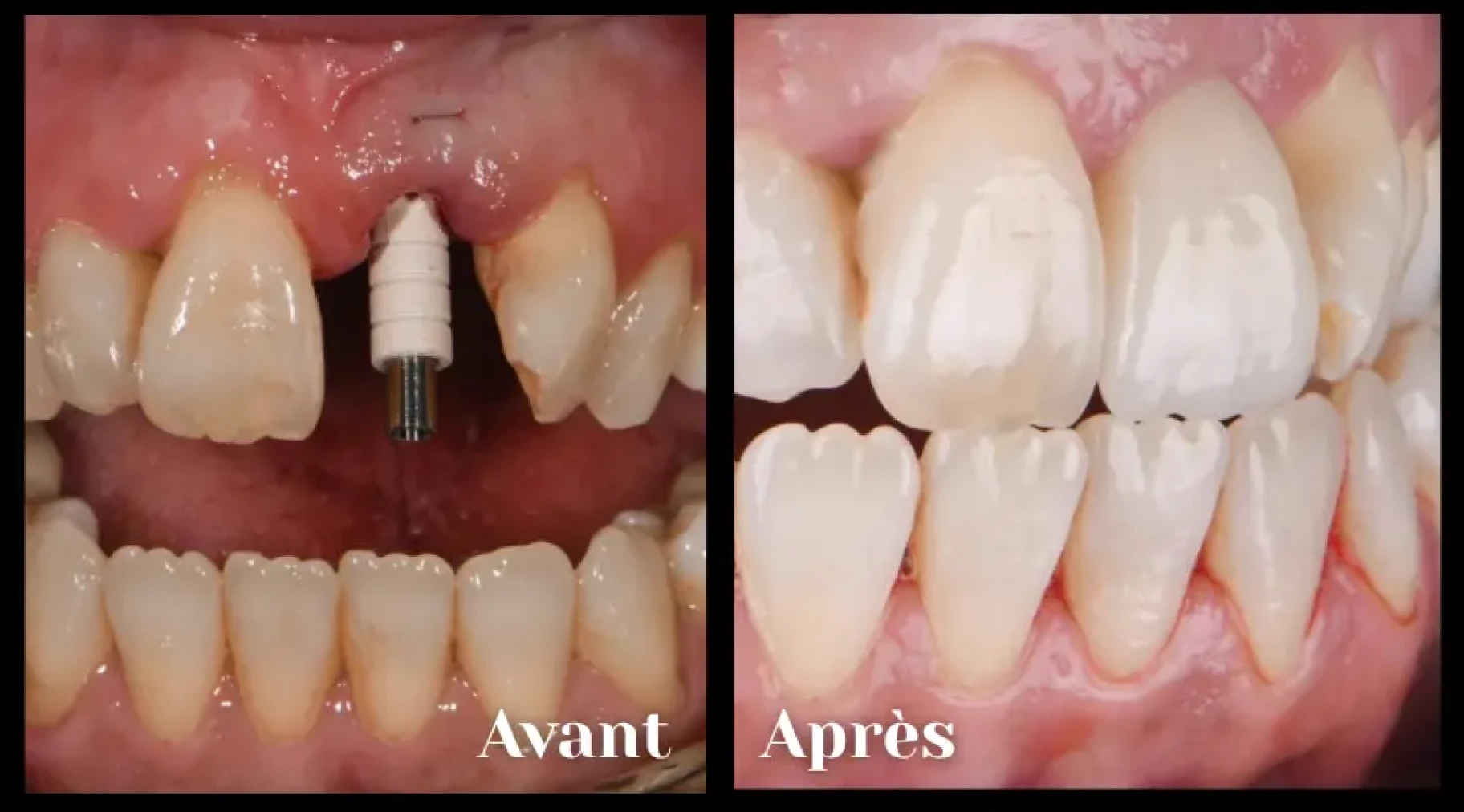 Exemple implant dentaire à Toulouse 