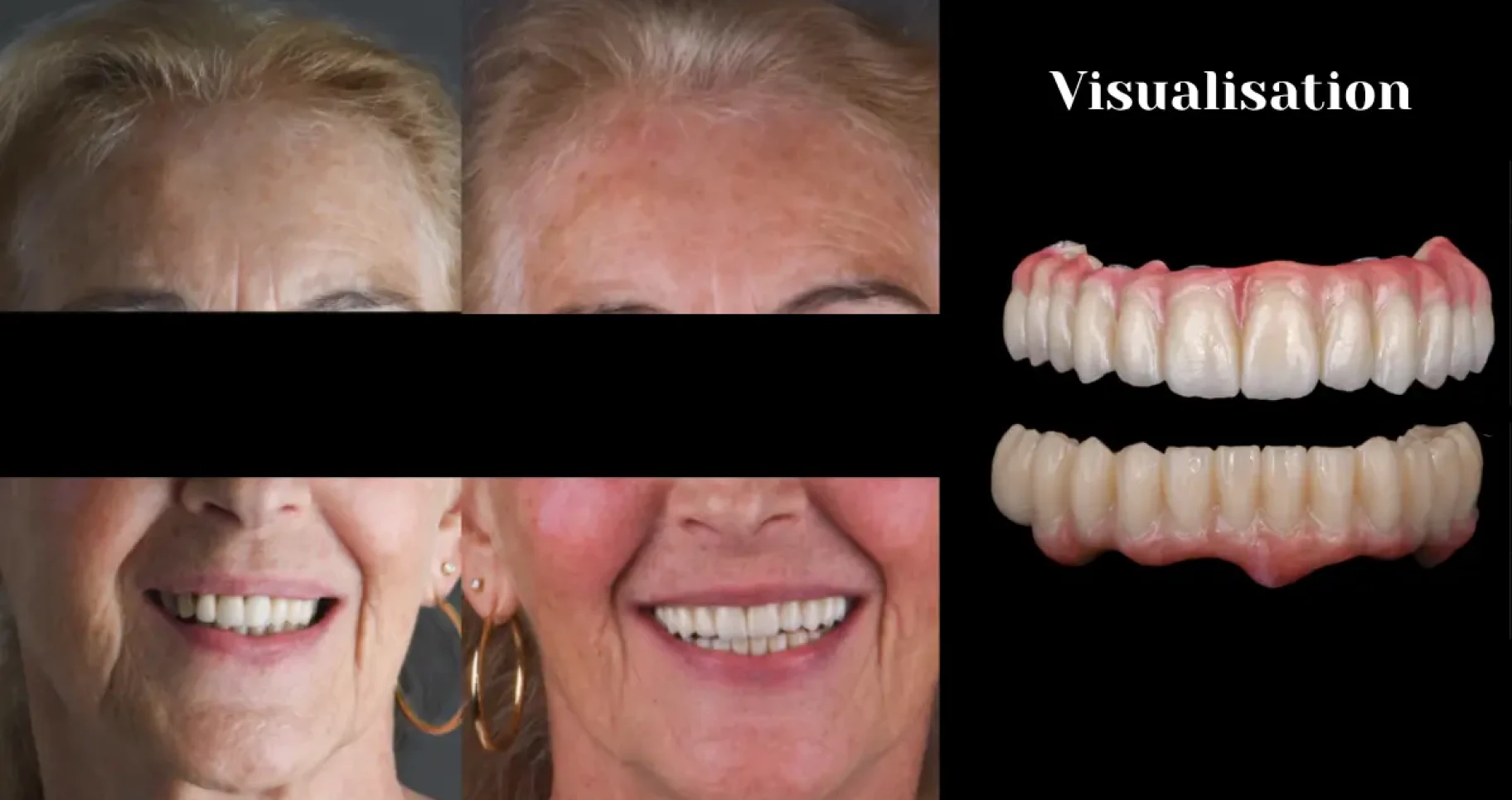 Visualisation Implant dentaire Toulouse