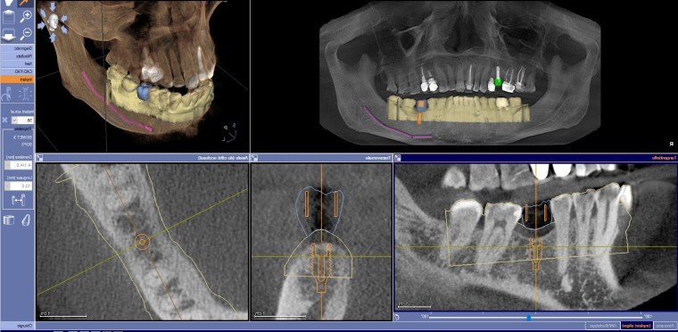 Dr Benichou chirurgien dentiste confort technologie Toulouse