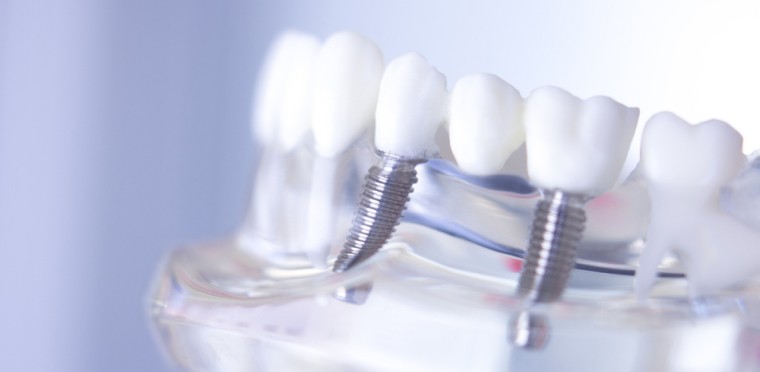 implant dentaire blog Dr Benichou Toulouse