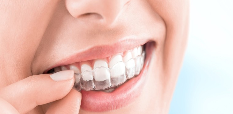 traitement Invisalign Dr Benichou blog Toulouse