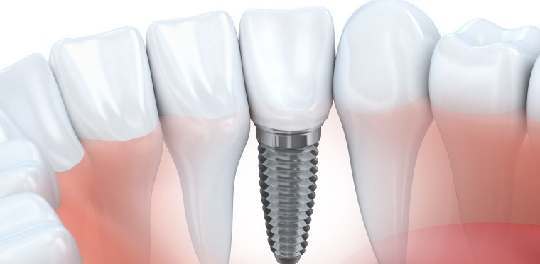 Peut-on retirer un implant dentaire ?