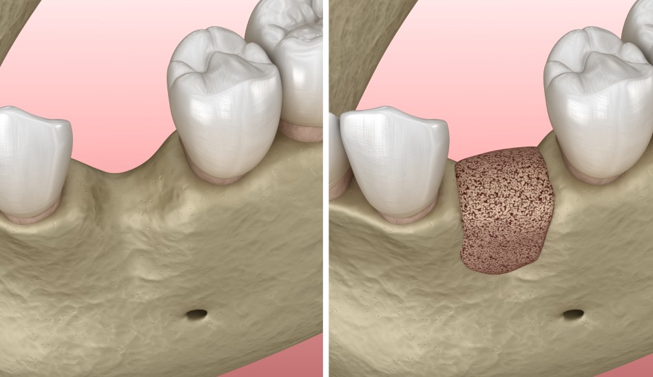 Docteur Benichou greffe osseuse implant Toulouse