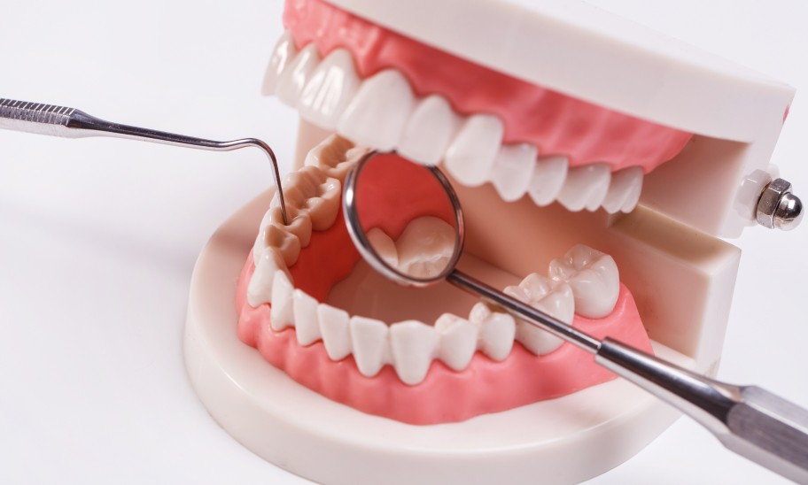 Bridge dentaire à Toulouse