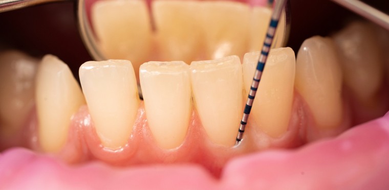 Poche gingivale : définition et traitements