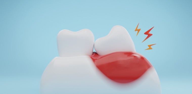 Récession gingivale : tout savoir