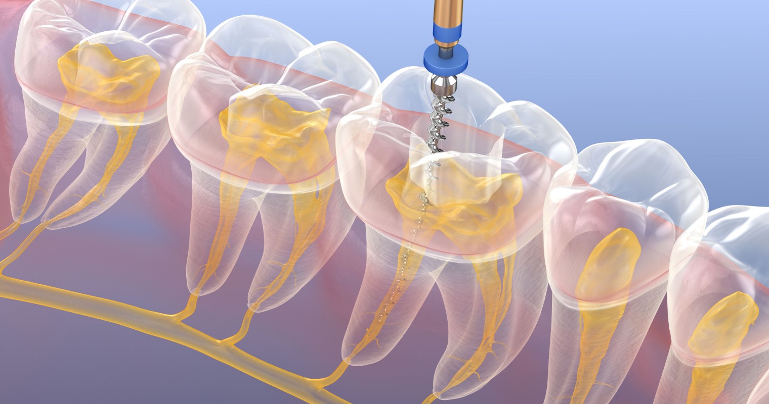 Tout savoir sur l’endodontie
