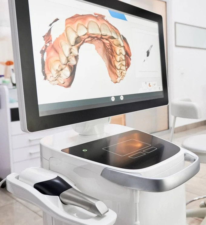 L’empreinte optique numérique 3D Itero à Toulouse