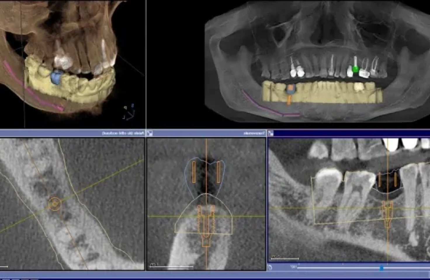 Guide chirurgical au cabinet du Dr Mathieu Benichou à Toulouse