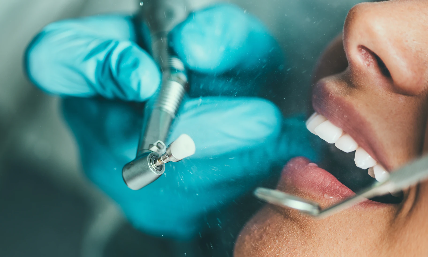 Polissage dentaire chez le dentiste Dr Benichou à Toulouse