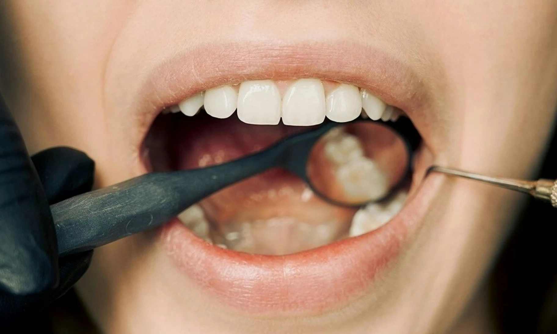 Parodontite : avis de dentiste, causes et traitements