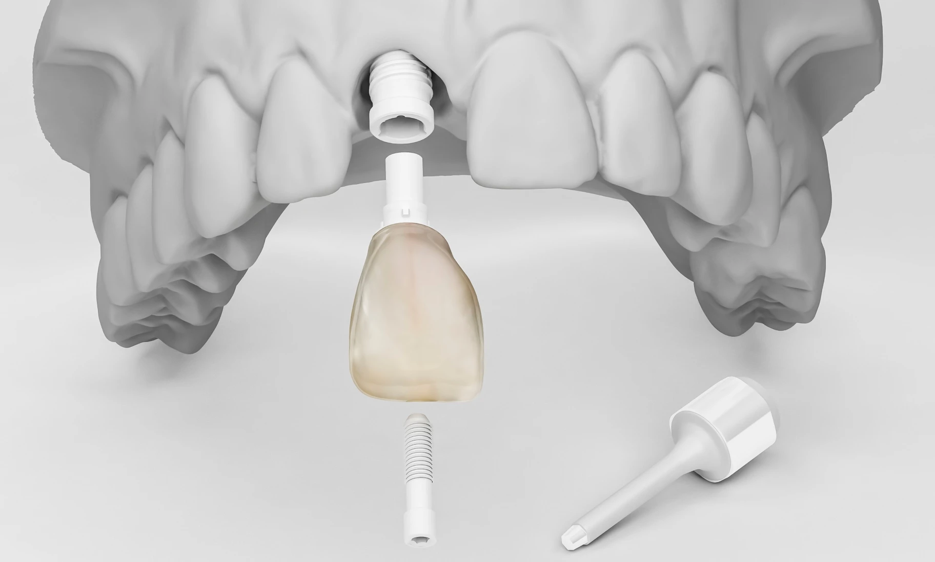 Implants Céramiques en Zircone