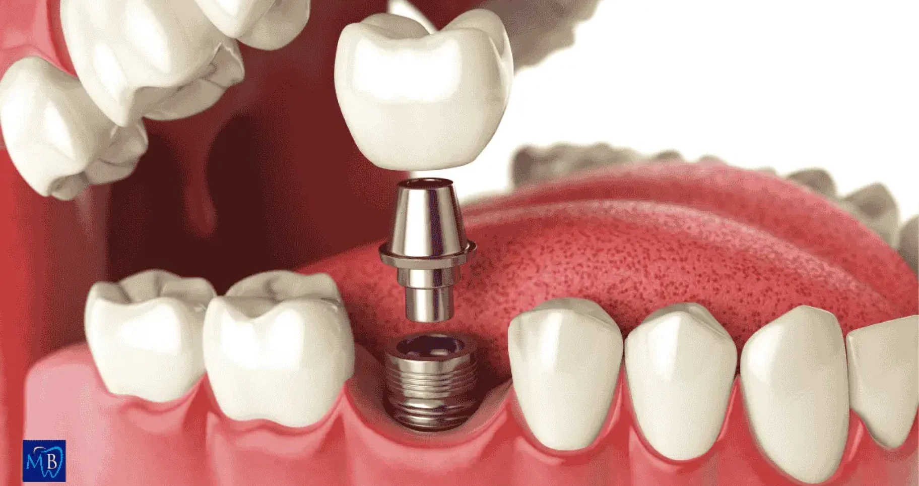 Combien d'implants dentaires peut-on poser en une fois ?