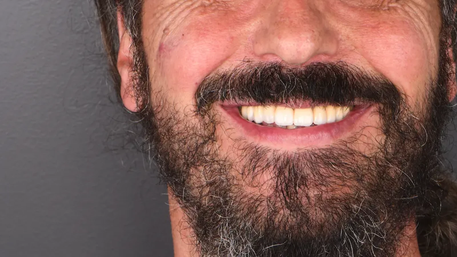 All-on-4 : la nouvelle technique d'implants