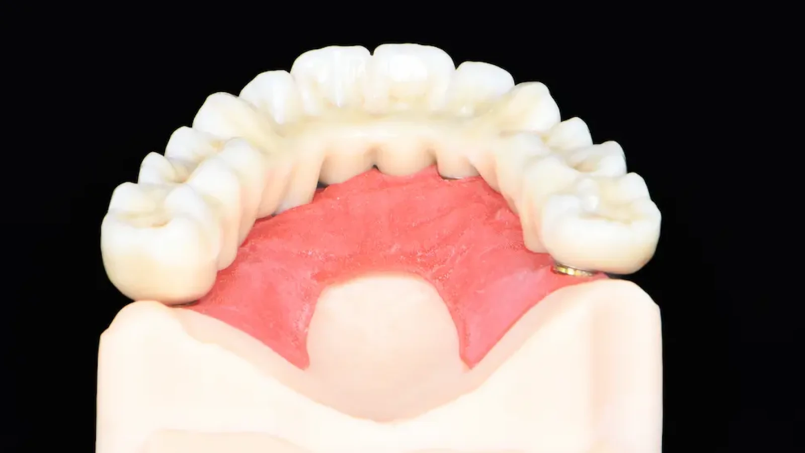 All-on-4 : la nouvelle technique d'implants