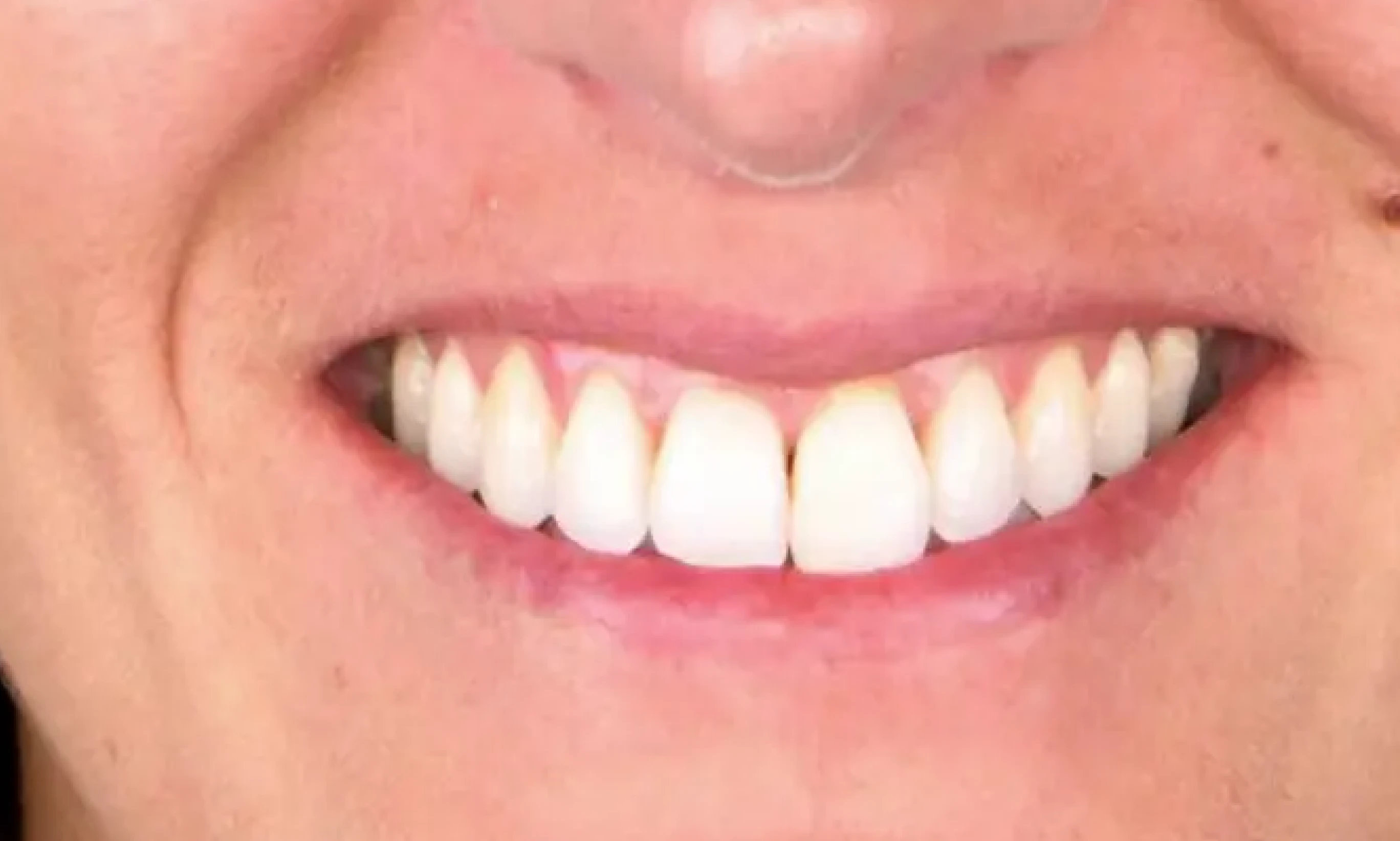 Surfaçage radiculaire : guide du traitement et conseils