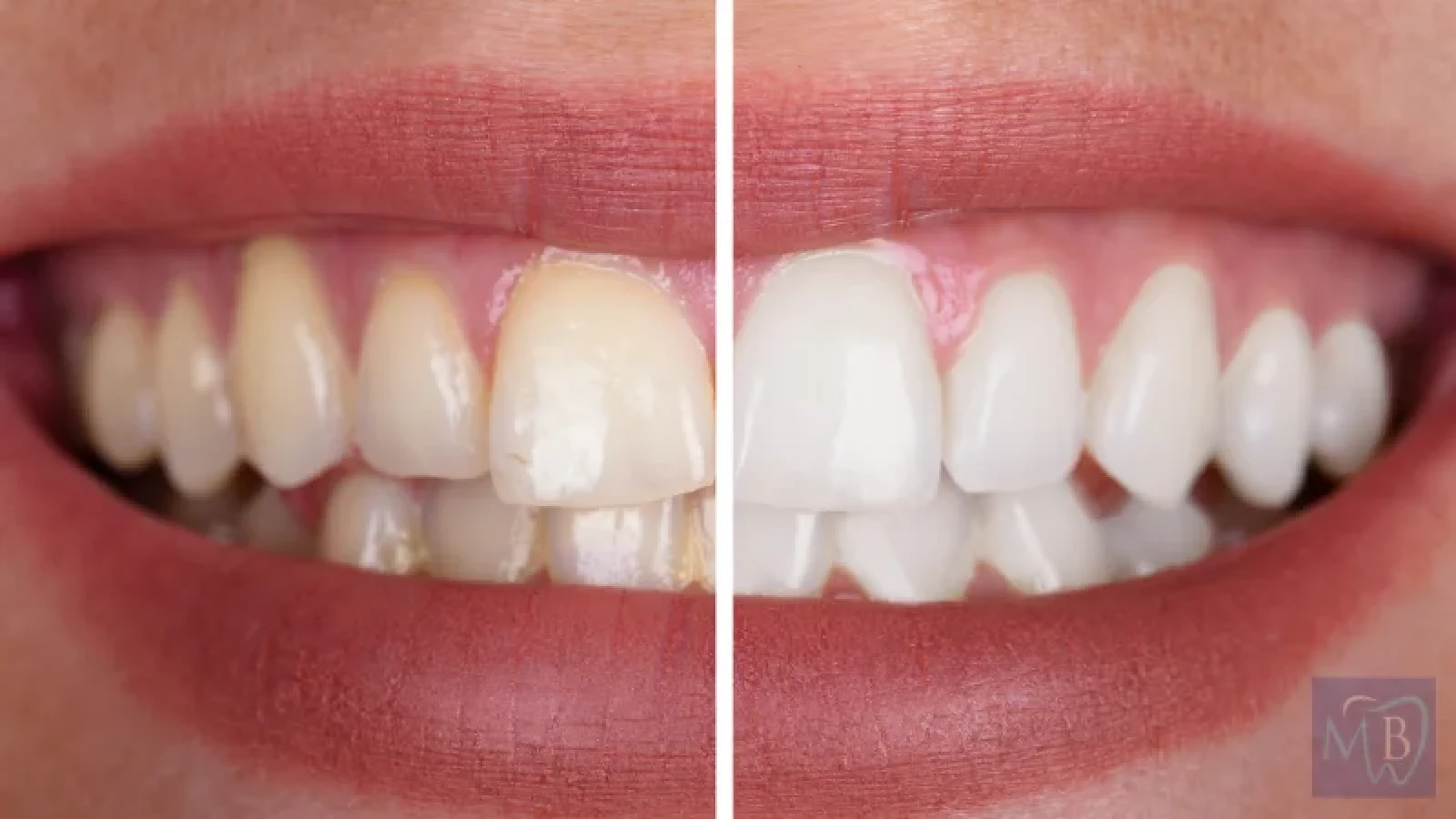 Comment blanchir les dents ? Solutions efficaces